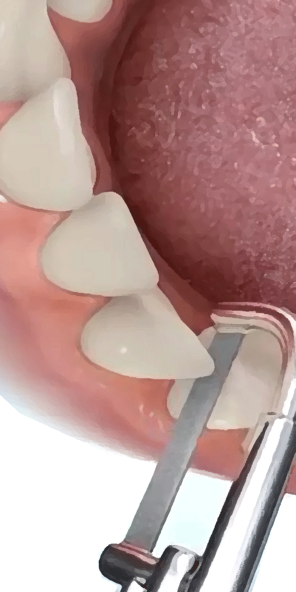 BMI der Zähne: Slendering